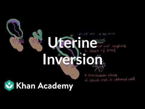 Uterine inversion | Reproductive system physiology | NCLEX-RN | Khan Academy