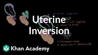 Uterine inversion | Reproductive system physiology | NCLEX-RN | Khan Academy