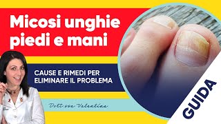 Micosi unghie: le cause e i rimedi per eliminare il problema |  Semprefarmacia.it