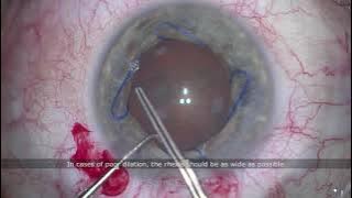 Combined cataract surgery   iStent Inject W & Malyugin Ring