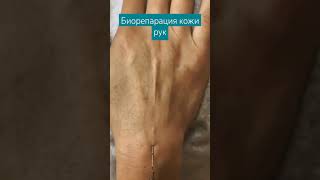 Биорепарация кожи рук, быстро, эффективно и без синяков и боли.