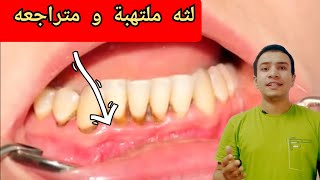 4 مراحل لالتهاب و تراجع اللثه + علاج فعال للثه الملتهبه و المتراجعه