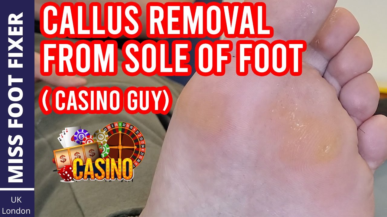 SATISFYING THICKEST AND GIANT CALLUSES REMOVAL BY MISS FOOT FIXER 