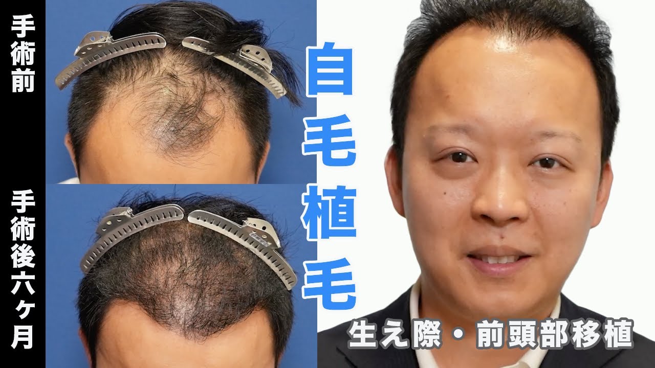 Hair Transplantation 第6版 Hair Transplantation 第6版 Hair