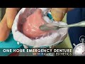 Full process one hour special emergency denture with high esthetics