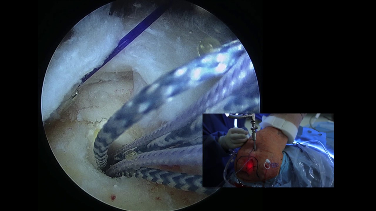 Arthroscopic Rotator Cuff Repair and Bicep Tenodesis: Right