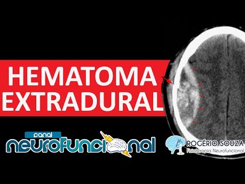 Vídeo: Diferença Entre Peridural E Subdural