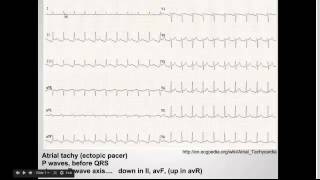 Approach to Tachyarrhythmias:  