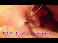 MUST WATCH TOP 3 SATISFYING BLACKHEAD EXTRACTION On YouTube
