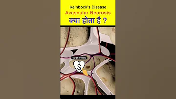 What is Avascular Necrosis | keinbock’s disease क्या है ? #shorts #avascularnecrosis