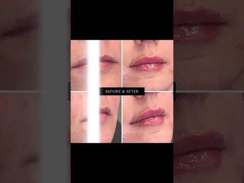 Dermal Fillers At Sands Aesthetics