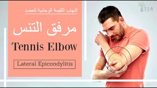 مرفق التنس - التهاب اللقيمة الوحشية - التهاب الكوع  Tennis Elbow - Lateral Epicondylitis (subtitled)