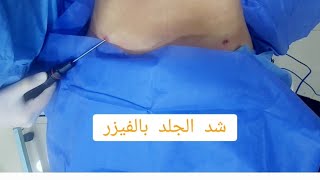 شفط دهون البطن والصدر بالفيزر والميكرو اير مع د محمد الهيتمى