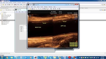 A Comparison of ultrasound Intima-media Thickness Measurements of the Left and Right Common Carotid