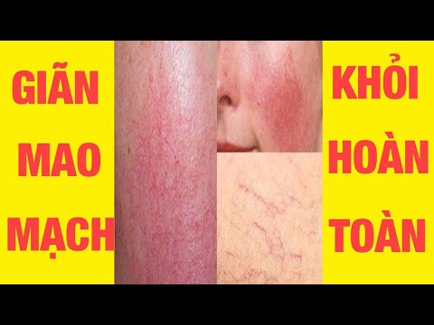 Video Điều trị giãn mao mạch do Thạc sĩ Bác sĩ tại PK Da... - youtube