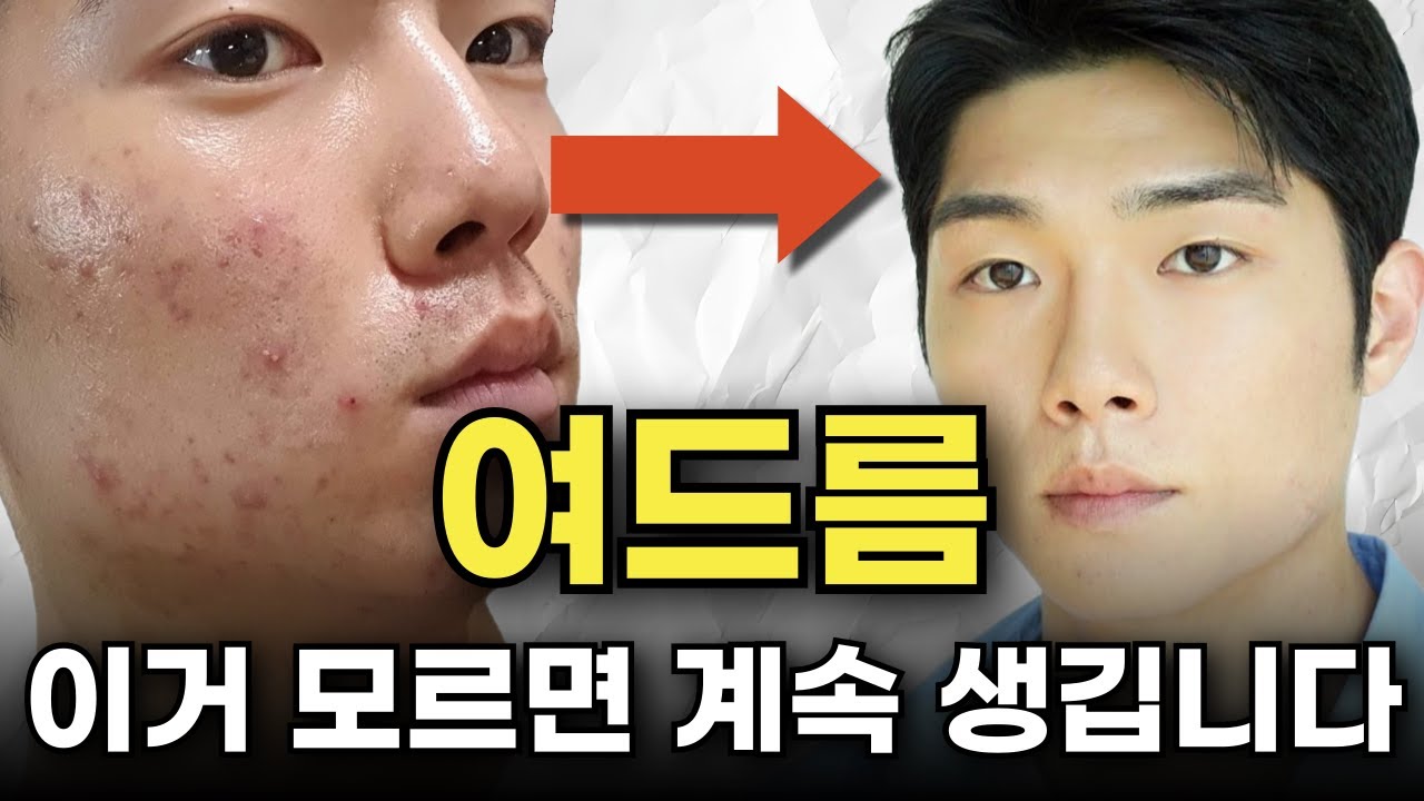여드름... 이거 모르면 절대 안 없어집니다. 여드름 10년차가 단번에 박멸한 방법 / 여드름 개박살 시리즈 ep.1