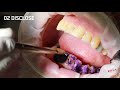 How to Maintain Dental Health While Undergoing Cancer Treatment