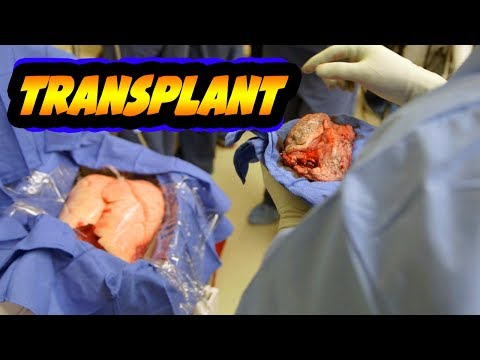 Miracle Lung Transplant Saves Lives!