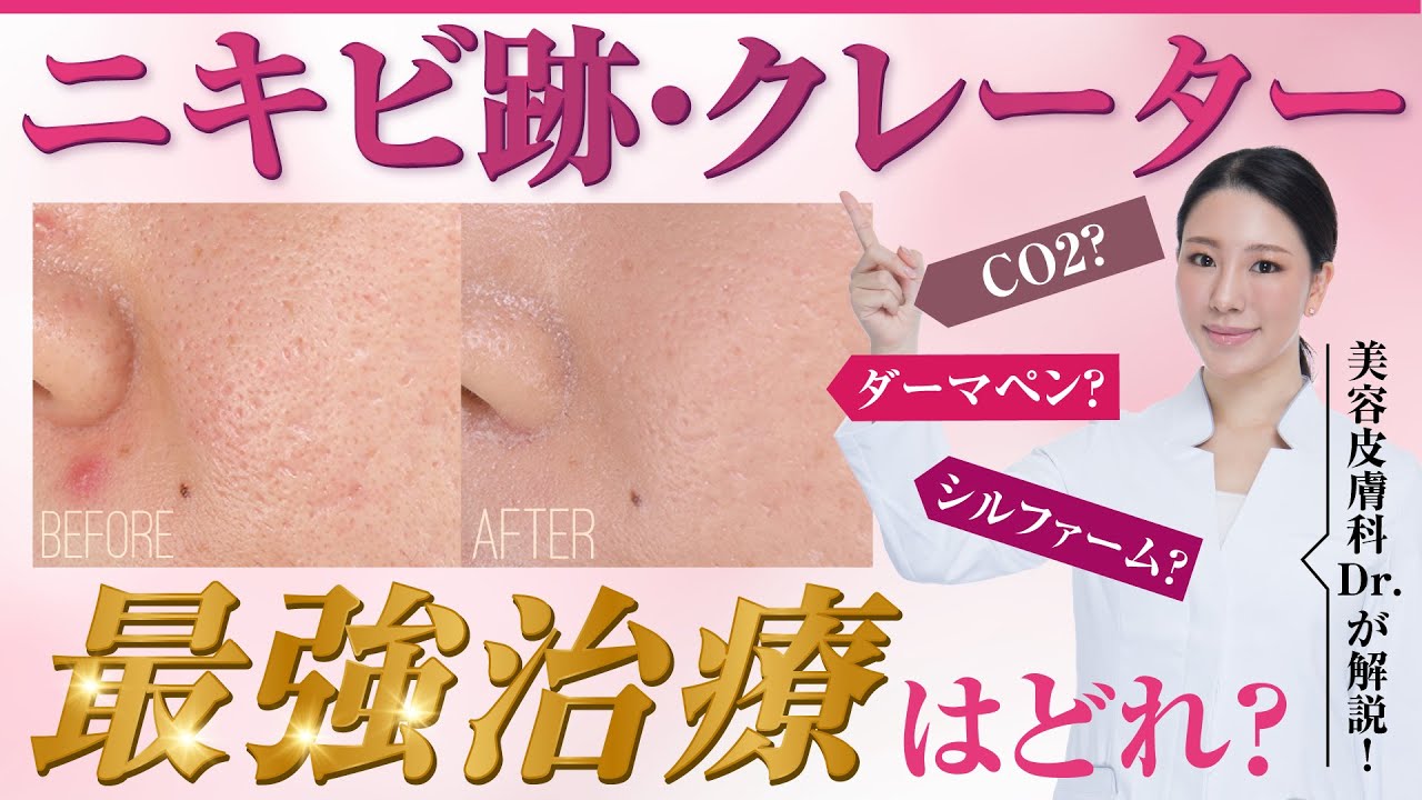 ニキビ跡・クレーター肌を治す最強治療は!？西川が解説!