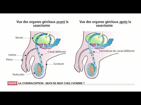 VASECTOMIE: COMMENT ÇÀ MARCHE ?