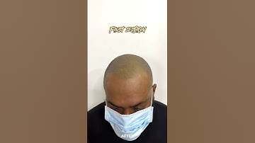 He came all the way from lakshadweep for SMP. #scalpmicropigmentation #smp #hairlosssolution