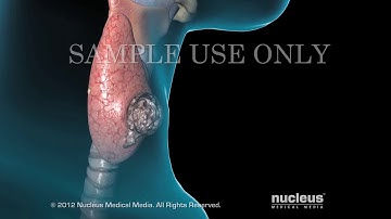 Thyroid Cancer