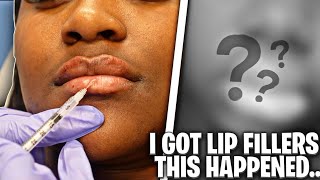 I Can't Believe I Got Lip Fillers!!!