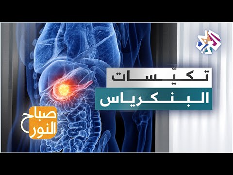 تكيّسات البنكرياس .. الأسباب والعلاجات