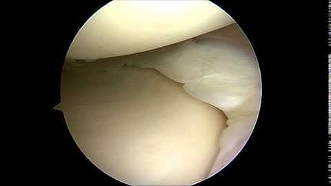 Partial Meniscectomy of a Bucket Handle Medial Meniscus Tear