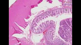 Histopathology Colon --Adenocarcinoma