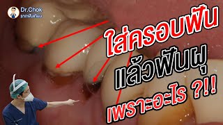 ใส่ครอบฟันอย่างไร ไม่ให้ฟันผุ คลิปนี้มีคำตอบ ?!!! | คลายปัญหารากฟันเทียมกับหมอโชค