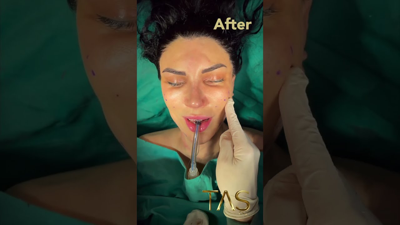 Revolutionary Scarless Facelift Transformation By Dr Suleyman Tas