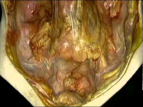 02 Cavidad Abdominal Y Peritoneo