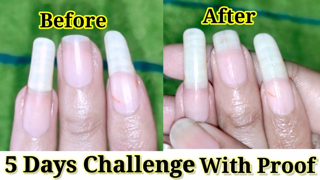 Amazon.com : Nutra Nail 5 to 7 Day Growth Treatment & Triple Power Gel  Treatment : Beauty & Personal Care