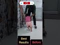 #cp bachcho ko sahi time se therapy krane se bachche thik ho sakte hai ##physiotherapy