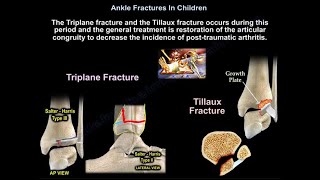 Ankle Fractures In Children - Everything You Need To Know - Dr. Nabil Ebraheim