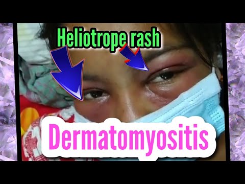 Video: Heliotrope Rash: Zakaj Se To Zgodi In Kako Se Zdravi