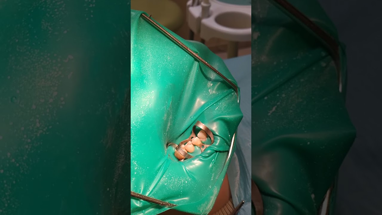 Isolation 46-43 teeth.