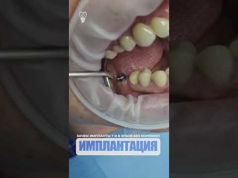 Зачем импланты 7 и 8 зубов без коронок? implants of 7 and 8 teeth without crowns?