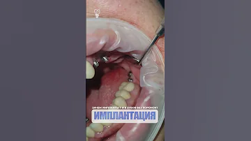 Зачем импланты 7 и 8 зубов без коронок? implants of 7 and 8 teeth without crowns?
