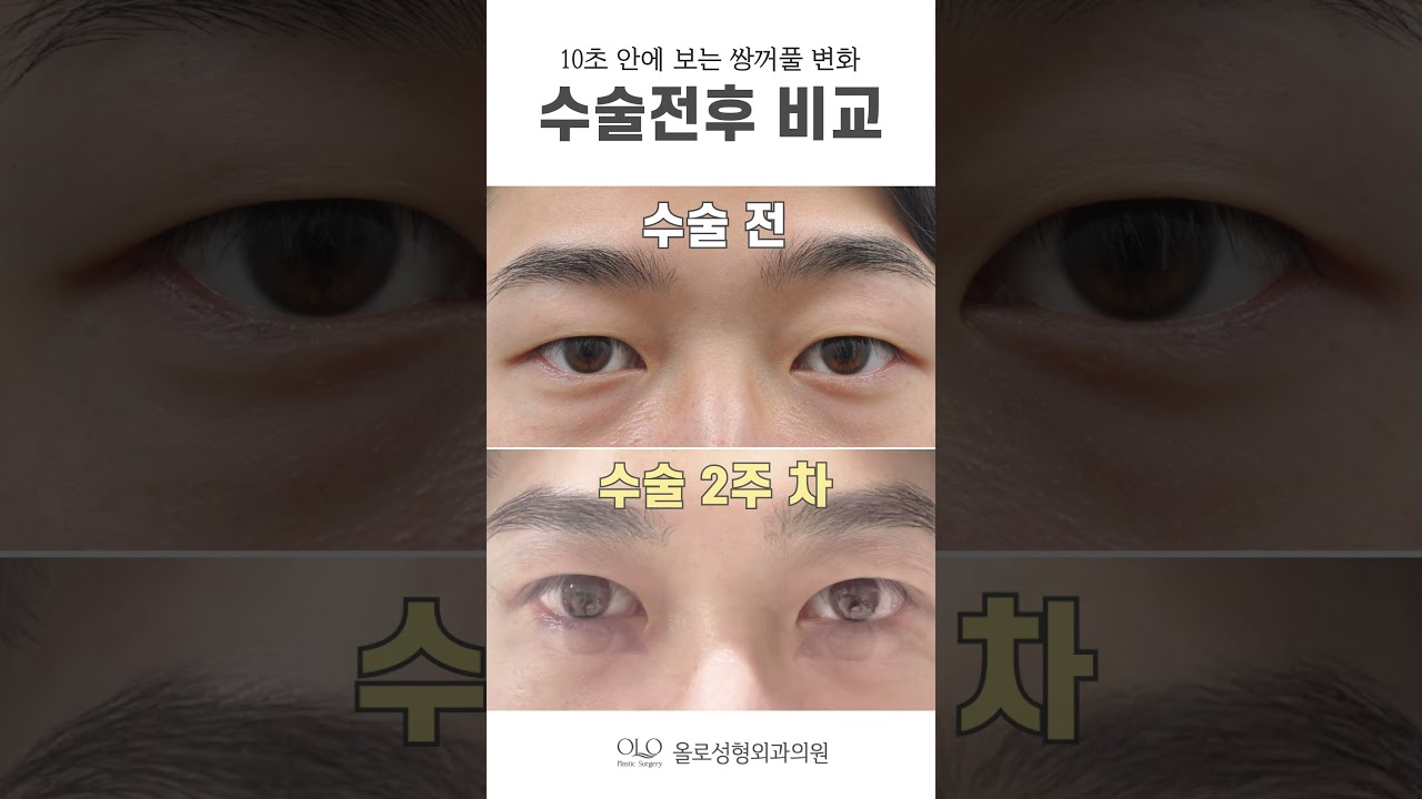 [奧路整形外科醫院] 總是煥然一新！清晰明亮是最好的！ #男性眼部整形 #短片