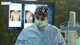 Breast augmentation assisted by Stromal Enriched Lipograft  / Live Surgery / Dr. Aris Sterodimas