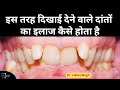 इस तरह के टेढ़े-मेढ़े दांतों का इलाज कैसे करते हैं || Dr Lahna Singh ||