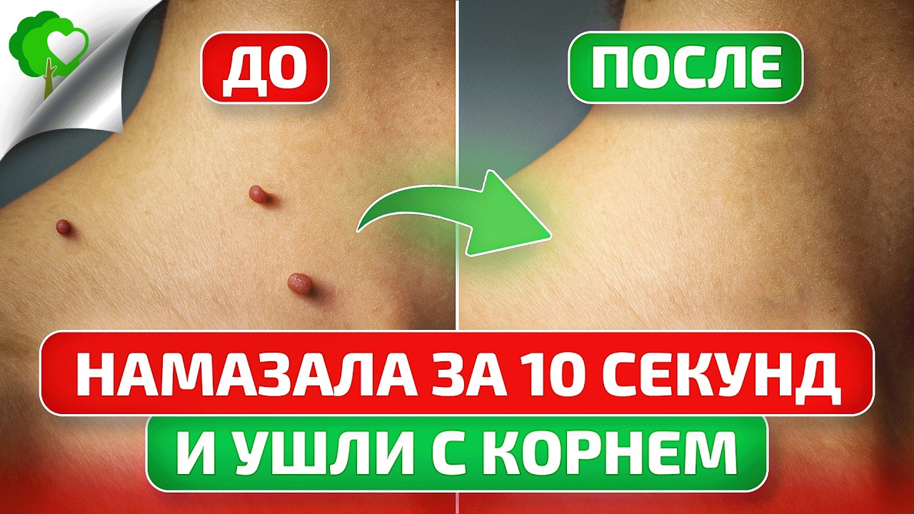 Как отличить ПАПИЛЛОМЫ от ДВОЙНИКОВ и избавиться от них НАВСЕГДА? Папилломы уходят с корнем.