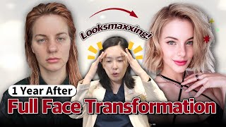 Post-Op at One Year: How Her Face Changed After Surgery in Korea?