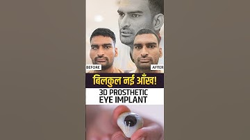 बिलकुल नई आँख: 3D Prosthetic Eye Implant