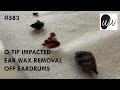 583 - Q-Tip Impacted Ear Wax Removal off Eardrums