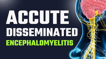 How to Treat Acute Disseminated Encephalomyelitis | #health