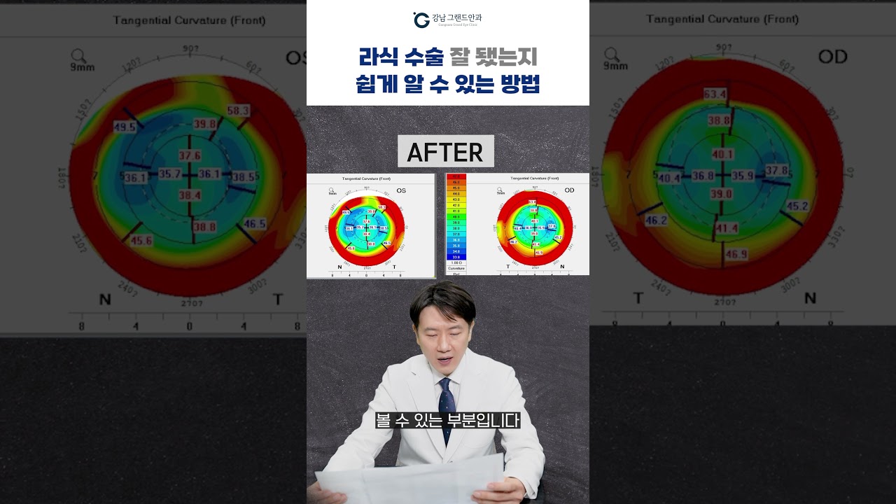 [Ганнам Гранд Нүдний Эмнэлэг] #шортс #ЛАСИК_ЛАСЕК_амжилттай_болсон_эсэх #Энгийн_хүн_ч_хялбархан_мэдэх_арга #Миний_нүдийг_би_өөрөө_үнэлнэ_!!