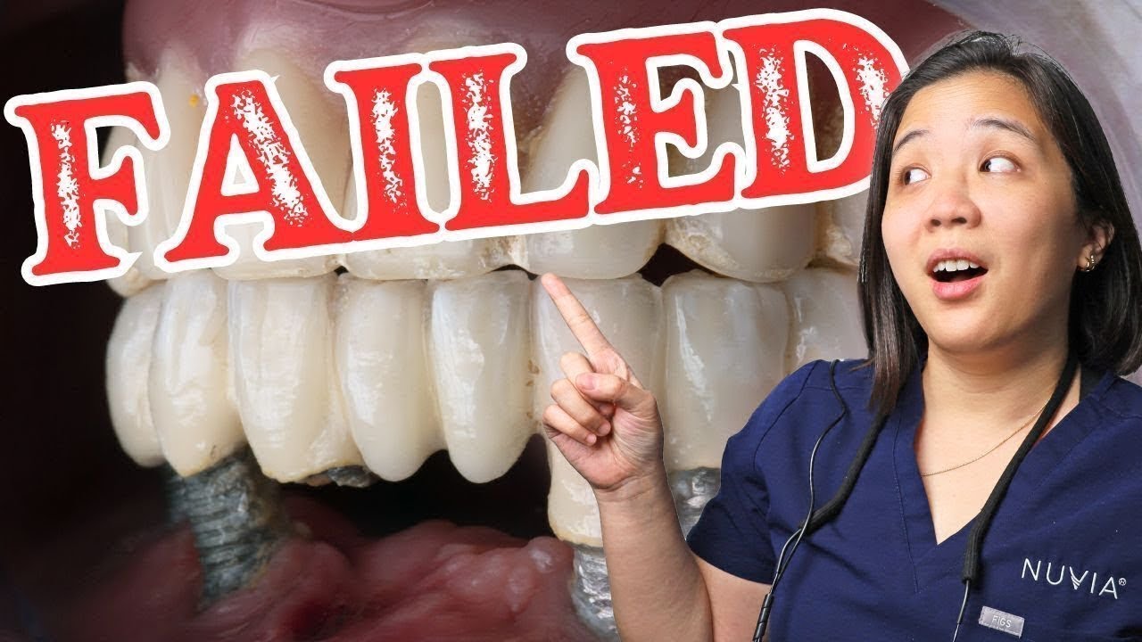 Outline Video Doctor Reveals Top 3 Reasons Dental Implants Fail